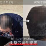 脱シャンプーのその後...。髪は本当に増えたのか!? 衝撃の結果