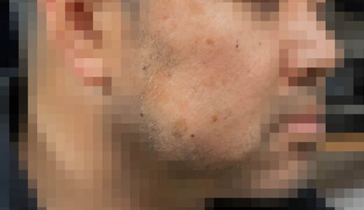 40代男性がレチノールで大量のシミ取りしてみた結果